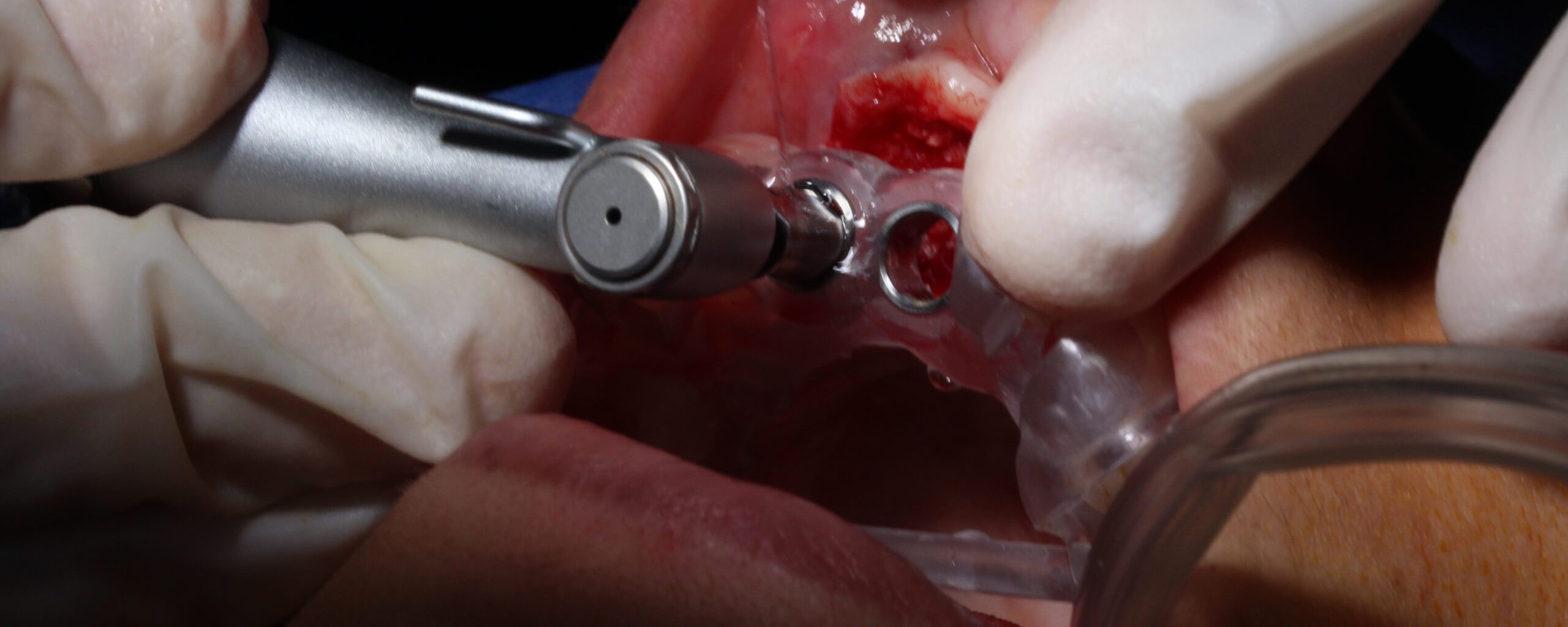 IMPLANTES 02